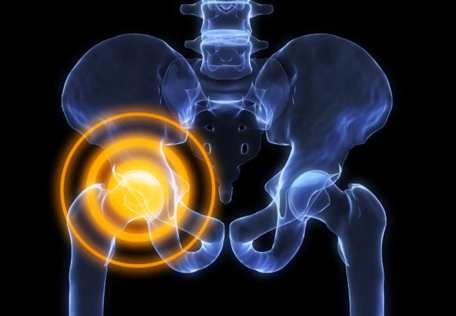Scoliosis hip pain indicator